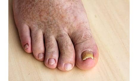 AAD Speaker: Accurate Diagnosis of Nail Fungus Key to Treatment