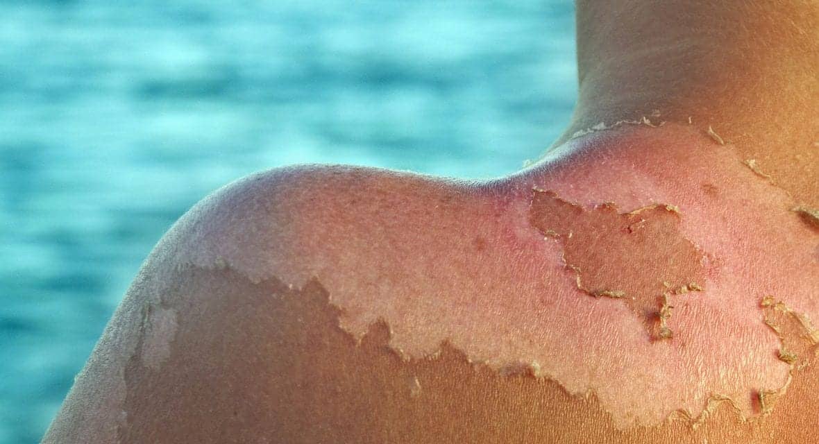 The U.S. Spends Millions on Treating Sunburns, Study Finds