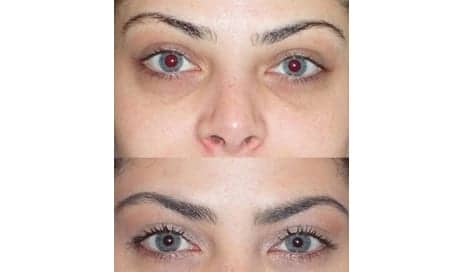 The Tear Trough Plastic Surgery Treatment Gets Rid of Dark, Under-Eye Circles