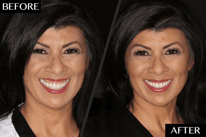 The Fast and Easy Way to Fix a Gummy Smile Without Surgery