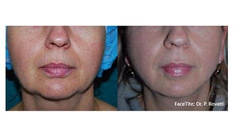 InMode Skin Tightening Technology is the Missing Link Providing Surgery Like Results Without Cutting, Can be Performed in the Office with Minimal to no Downtime