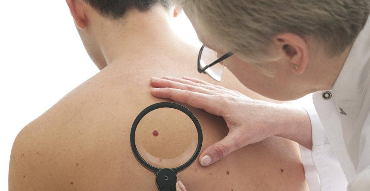 Moles Not the Only Way to Spot Deadly Melanoma