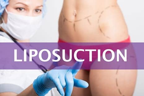 Liposuction May Ease Swelling in Cancer Patients