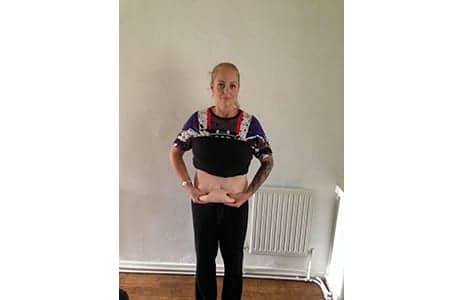 Woman Who Lost Six Stone Told She Couldn't Have an NHS Tummy Tuck Because She Wasn't Fat Enough