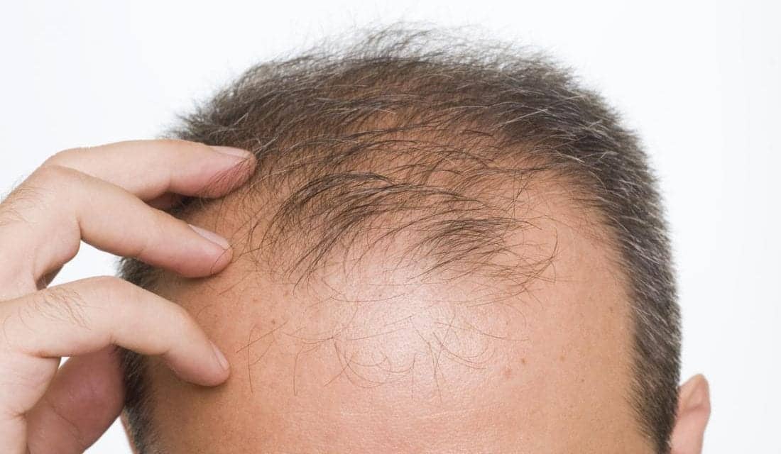 Hair Loss Most Common in Summer, Fall