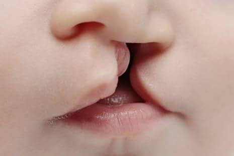 Anxiety, Depression Greatest in Younger Kids with Facial Birth Defects