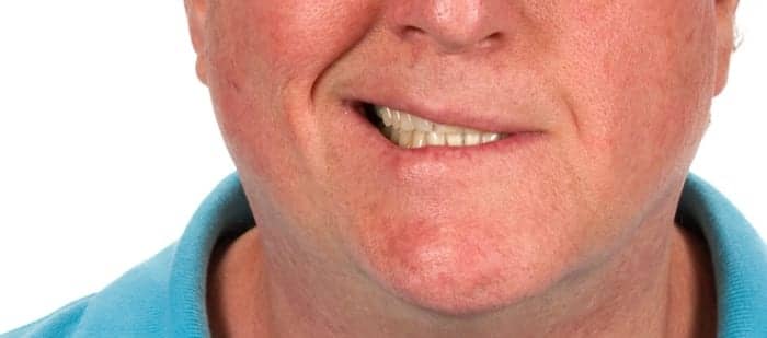 Botox Treatment Efficacy Examined for Facial Synkinesis