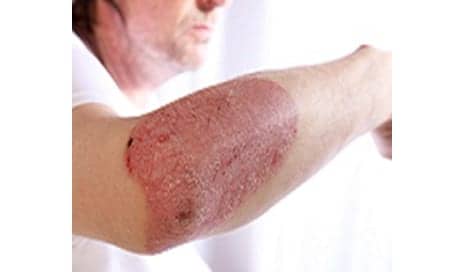 FDA Approves Stelara for Plaque Psoriasis