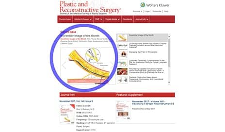 Method Developed to Minimize Damage On Sural Artery Perforator Flap Surgery
