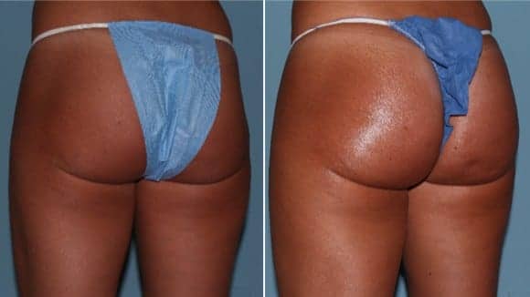 Non-Surgical Butt-Lifts Are the Latest Trend In Injectables