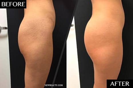 This Is What It Looks Like When You Get a ‘Sculptra Butt Lift’