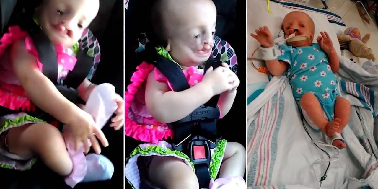 Little Girl Born with Half a Face Due to Condition Never Seen Before By Doctors