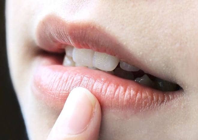 Public Service Announcement: Don’t Order Glue-On Veneers From the Internet