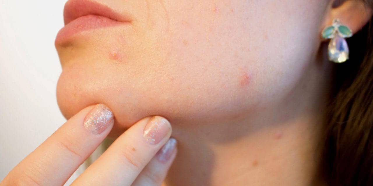 Bacterial Tug of War May Cause Acne