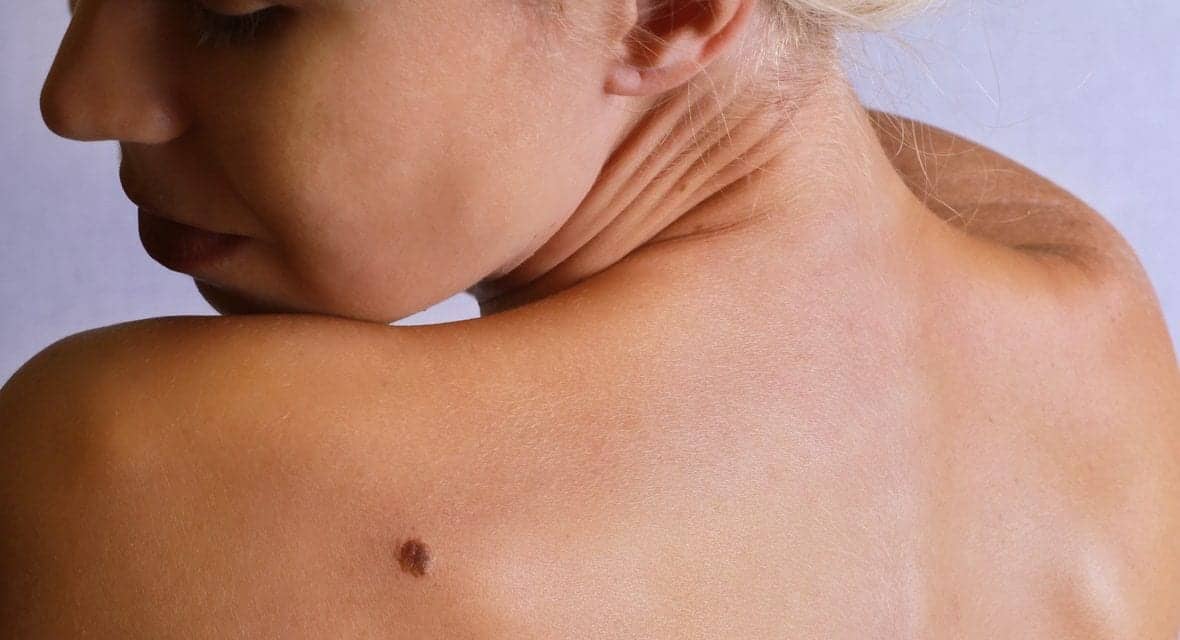 FDA Approves Treatment That Gets Rid of Skin Growths, a.k.a. Seborrheic Keratoses