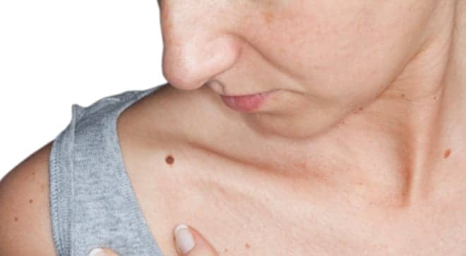 Identifying Safe Windows for Melanoma Surgery Improves Survival
