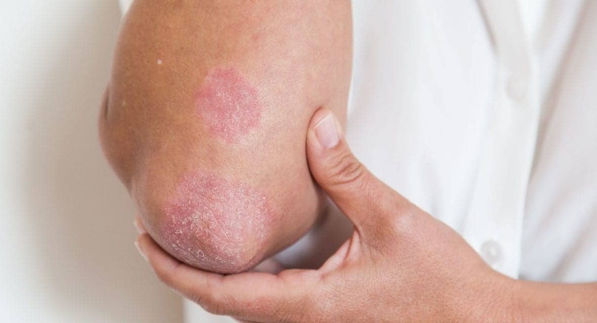 Vanilla Extract Could Help Treat Psoriasis, Says Study