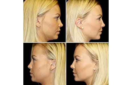 Just How Revolutionary is Stem Cell Injectable Facial Rejuvenation?