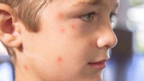 How to Care for Children with Chickenpox