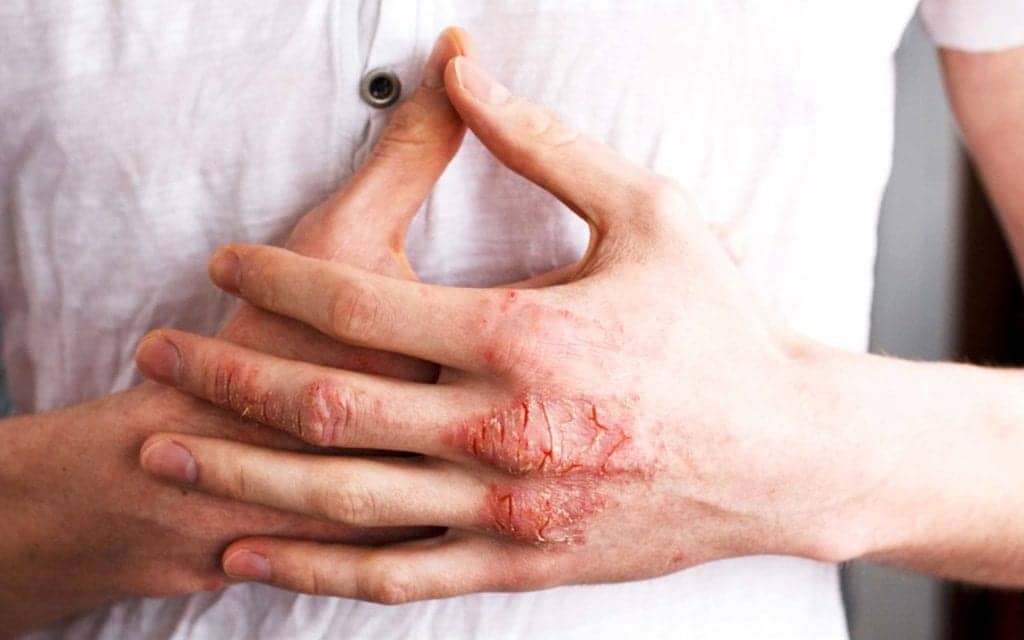 7 Eczema Treatments Dermatologists Use on Themselves