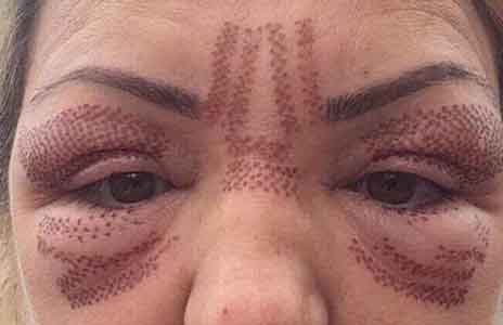 What One Rogue Beautician Told Undercover Reporter in a Bid to Give Her Botox Illegally