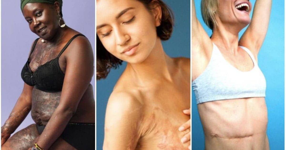 People Are Unapologetically Baring Their Scars In This Stunning Photo Series