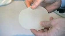 Rates of Rare, Breast Implant-Related Cancer May Be Higher Than Reported
