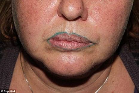 Woman’s Permanent Lip Tattoo Turns Green After Disastrous Cosmetic Procedure