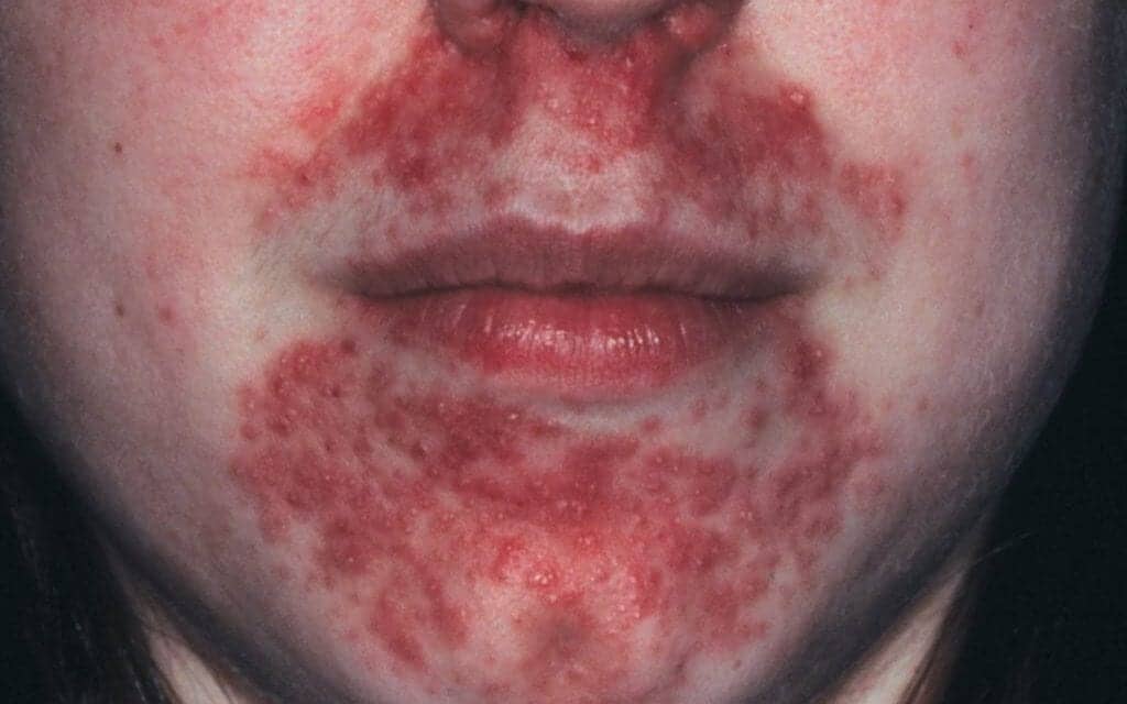 Here’s How You Should Treat Perioral Dermatitis, According to Dermatologists