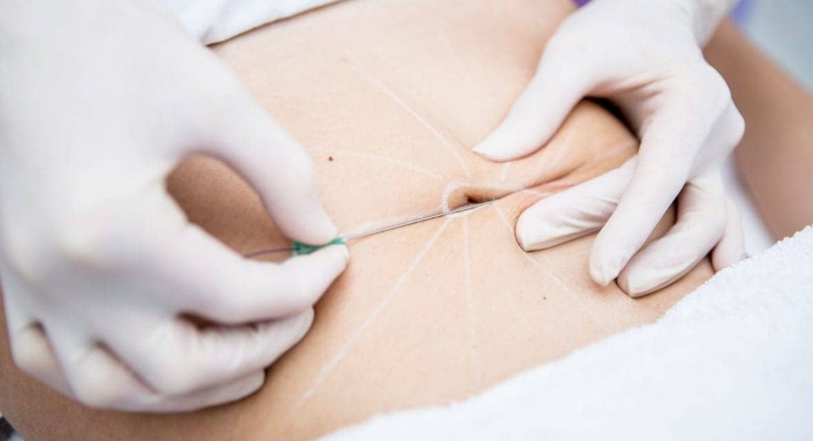 Why Belly Button Plastic Surgery Procedures Are Trending Right Now