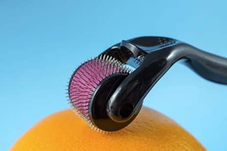 Microneedling: Experienced Hands Can Improve the Face