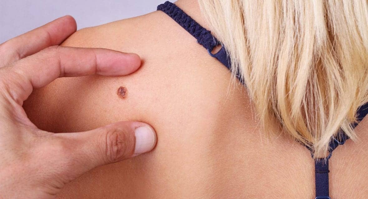 What to Know About Merkel Cell Carcinoma, a Rare Form of Skin Cancer That’s on the Rise