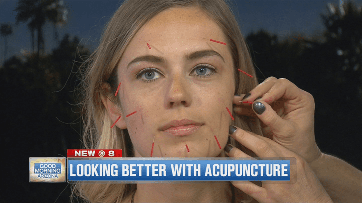 No Filter Needed – Enhance Your Allure with Cosmetic Acupuncture