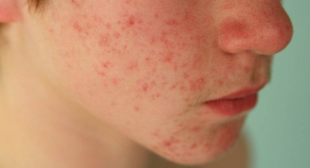 Isotretinoin, the Drug Formerly Known as Accutane, May Be Cited in Upcoming Murder Trial