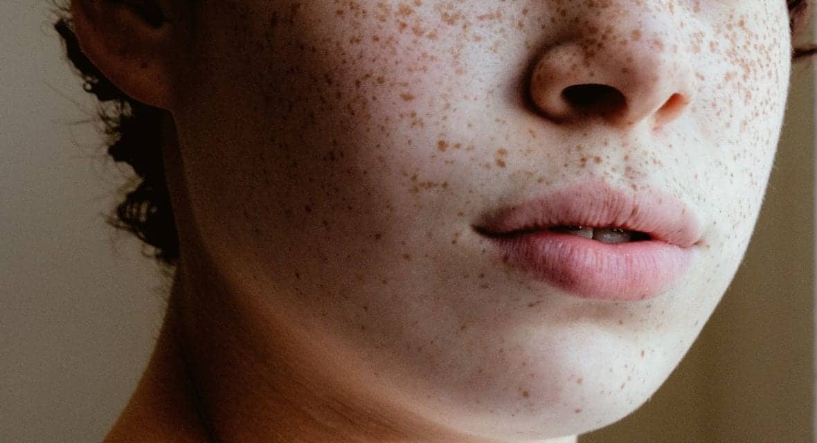 Skin Bacteria May Be Beneficial in Protecting Against Skin Cancer