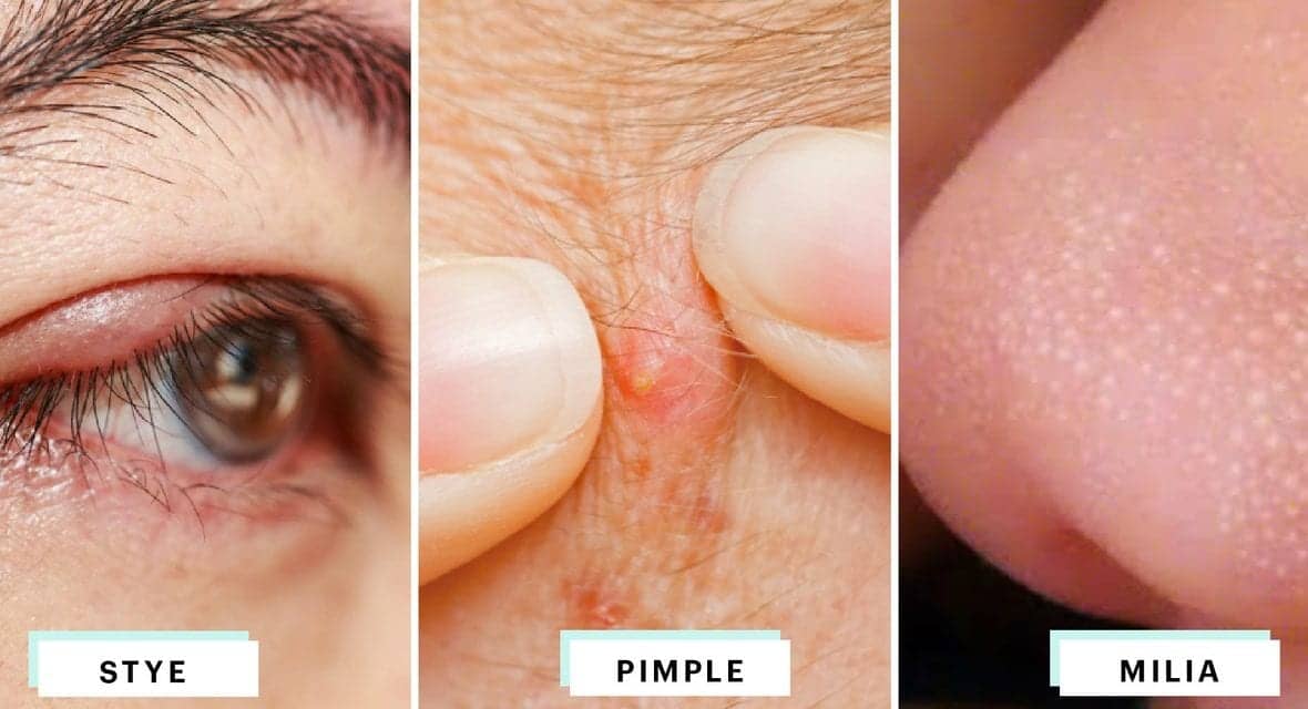 How to Identify Styes, Milia, and Pimples