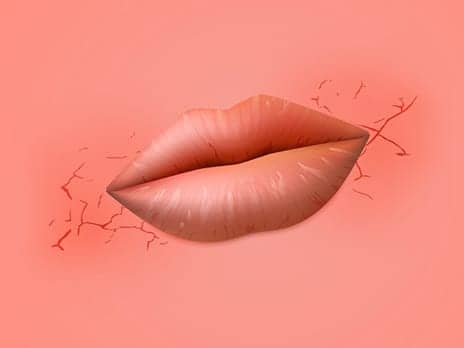 Why Do the Corners of My Mouth Crack—and How Do I Fix It?