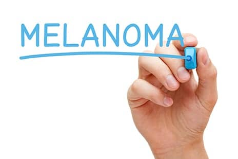 Married People Less Likely to Die From Melanoma