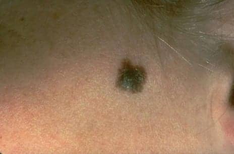 Study: Skin Cancer Survivors Less Likely to Die of Melanoma