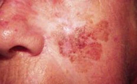 How Plastic Surgeons Are Advancing Skin Cancer Treatment