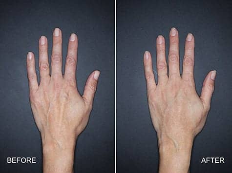 Nestlé Skin Health Announces the FDA Approval of Restylane Lyft for Hands