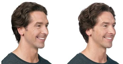 Allergan’s Botox Sets Its Sights On a New Customer: Men