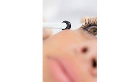Can Micro-Needling Really Make Acne Scars Disappear?