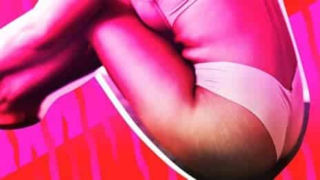 Experts Debunk the Biggest Myths About Stretch Marks