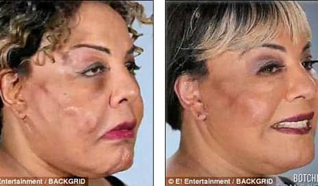 Transgender Activist Who Had Cement Fillers Injected Into Her Face Reveals Her Astonishing Transformation After Her Third Corrective Surgery