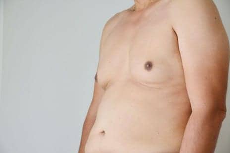 Why So Many Guys Are Getting Breast Reduction Surgery