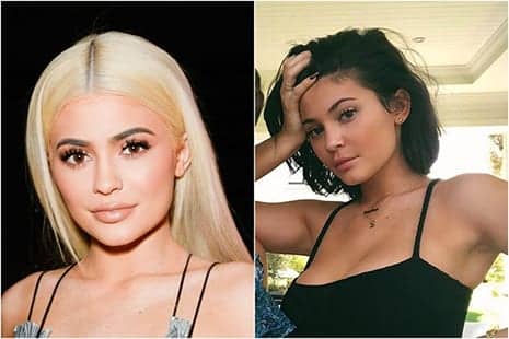 Getting Lip Fillers Removed: What You Need to Know