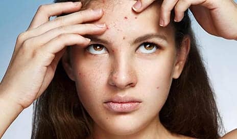 Best Acne and Pimple Prevention Tips to Avoid Blackheads, Whiteheads and Zits