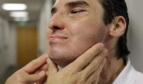 Chicago Surgeon On Face Transplants: ‘They Are a Very, Very Precious Commodity’