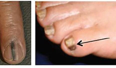 Nail Cancer Is Real, Miss Illinois Karolina Jasko Had This Type Of Melanoma